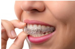 Teeth Alignment 2